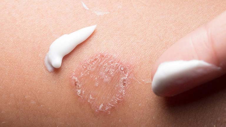 Điều trị bệnh hắc lào ở trẻ sơ sinh