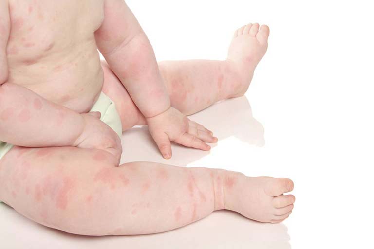 Phòng ngừa bệnh hắc lào ở trẻ sơ sinh