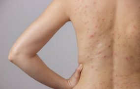 Viêm da tiết bã có tự hết không? Nhận định của bác sĩ