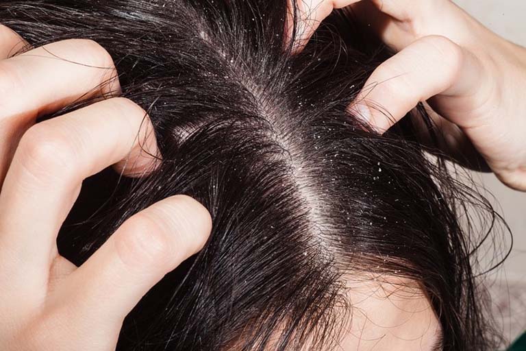 Những người không nên sử dụng dầu gội đầu hà thủ ô Những người không nên sử dụng dầu gội đầu hà thủ ô