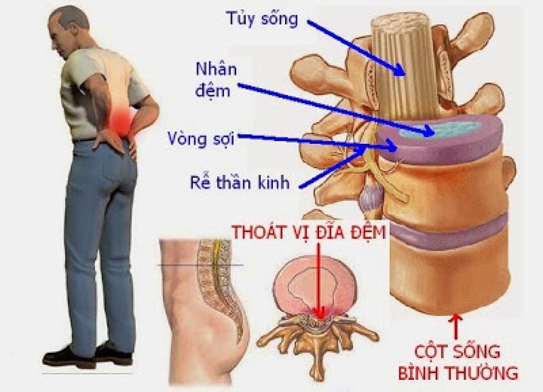 cách chữa thoát vị đĩa đệm tại nhà