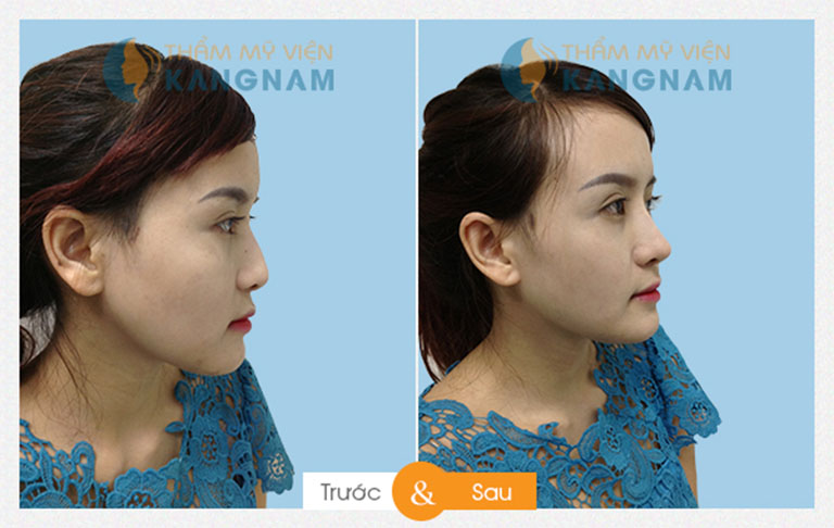 chỉnh hình đầu mũi, sửa mũi tại TPHCM