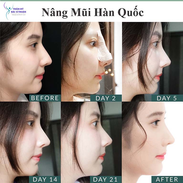 chỉnh hình đầu mũi, sửa mũi tại TPHCM