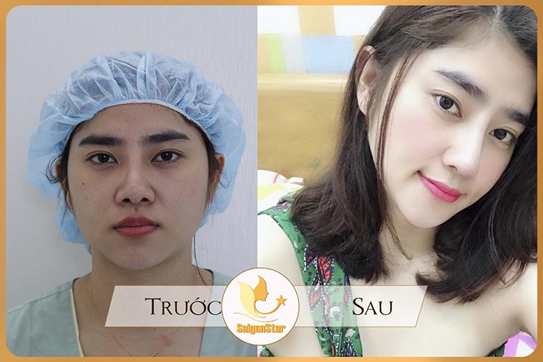 chỉnh hình đầu mũi, sửa mũi tại TPHCM