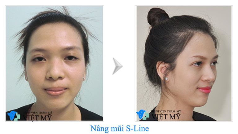 chỉnh hình đầu mũi, sửa mũi tại TPHCM