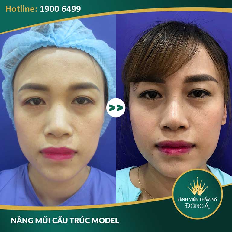chỉnh hình đầu mũi, sửa mũi tại TPHCM