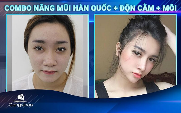 chỉnh hình đầu mũi, sửa mũi tại TPHCM