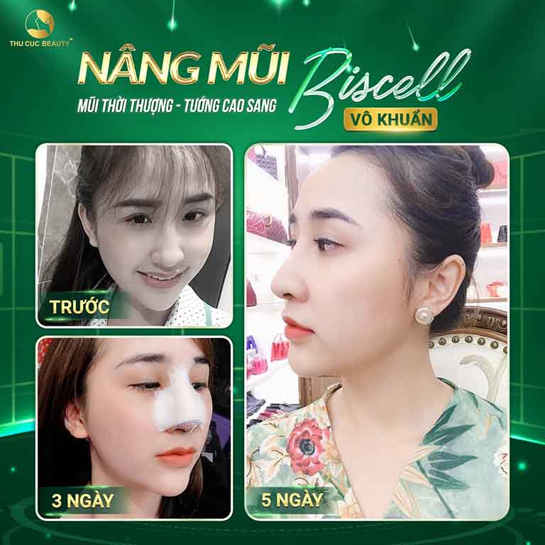 chỉnh hình đầu mũi, sửa mũi tại TPHCM