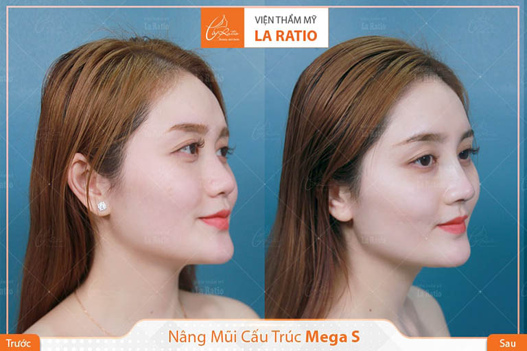 chỉnh hình đầu mũi, sửa mũi tại TPHCM