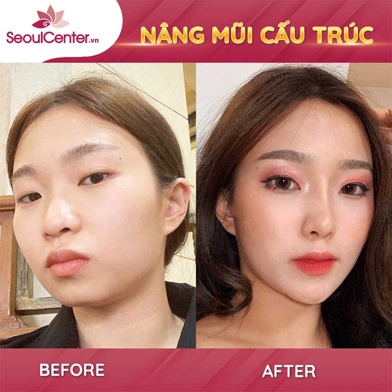 chỉnh hình đầu mũi, sửa mũi tại TPHCM