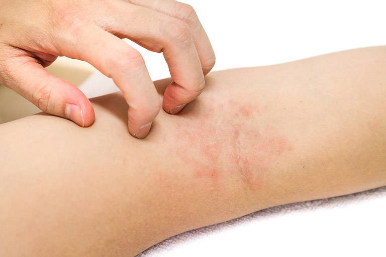 Lưu ý khi dùng lá đu đủ điều trị bệnh viêm da cơ địa