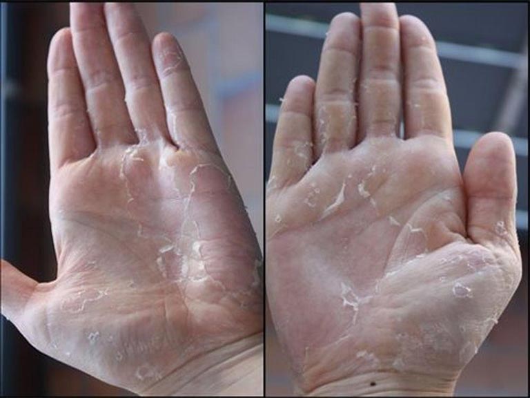 Lưu ý khi da tay bị bong tróc và ngứa