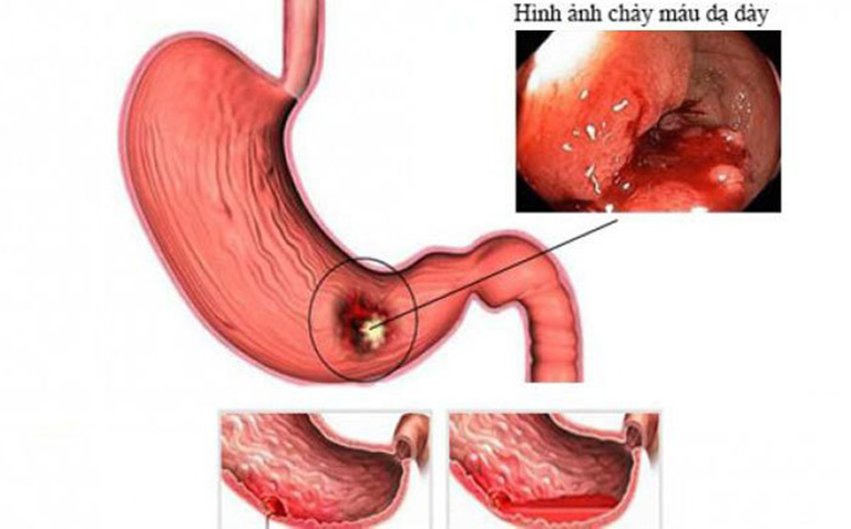 Đau dạ dày đi ngoài ra máu