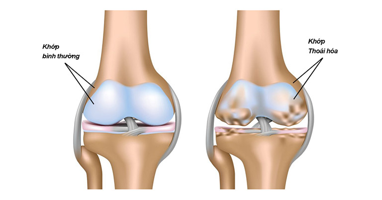 thoái hóa khớp gối