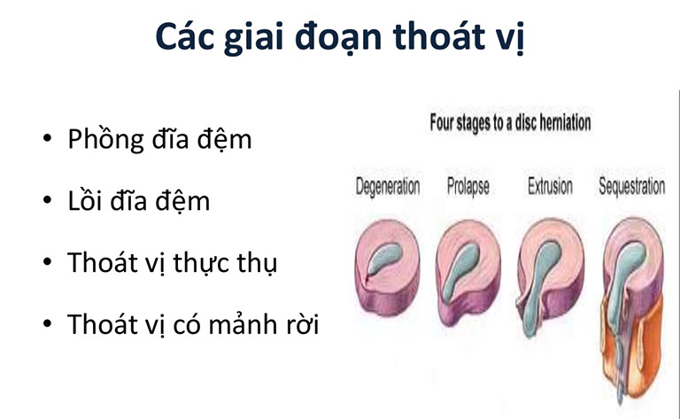 thoát vị đĩa đệm cột sống thắt lưng l5 s1