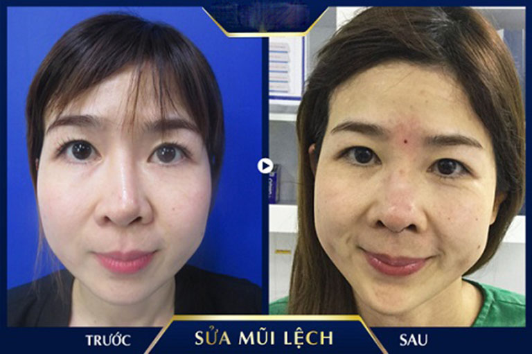 biến chứng sau khi nâng mũi