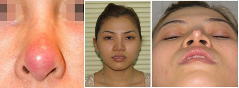 biến chứng sau khi nâng mũi