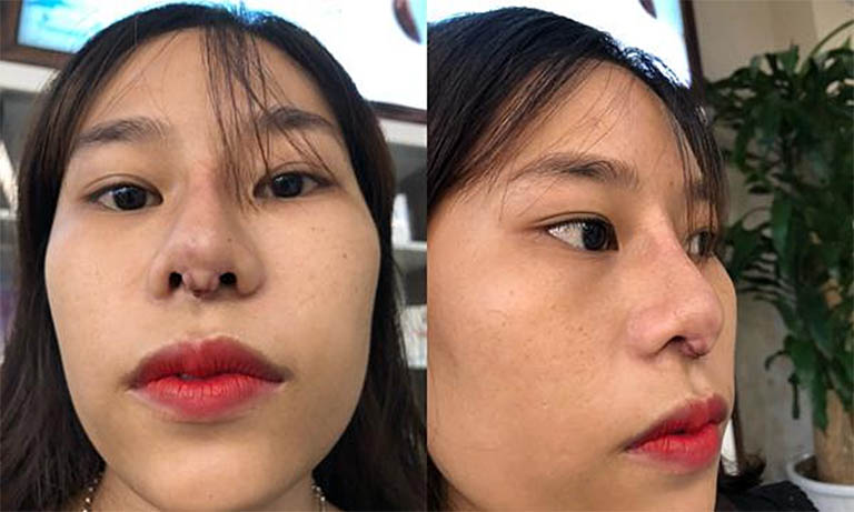 biến chứng sau khi nâng mũi