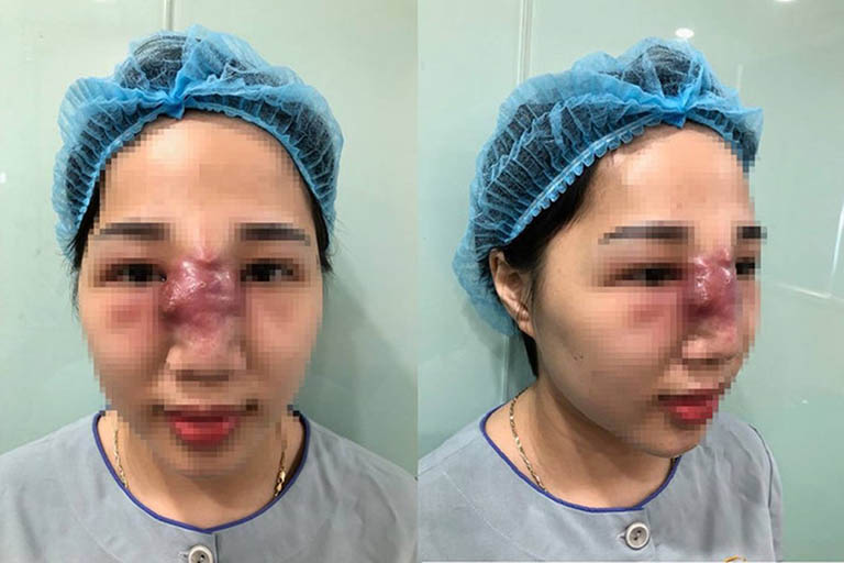 biến chứng sau khi nâng mũi