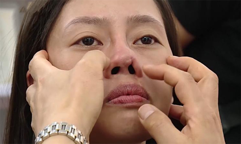 biến chứng sau khi nâng mũi