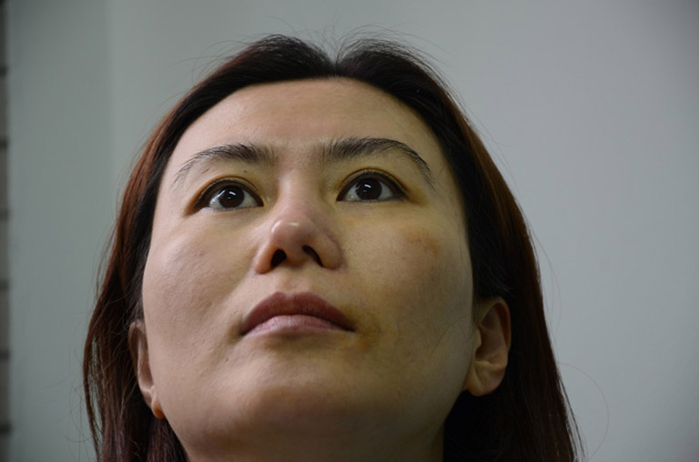 biến chứng sau khi nâng mũi