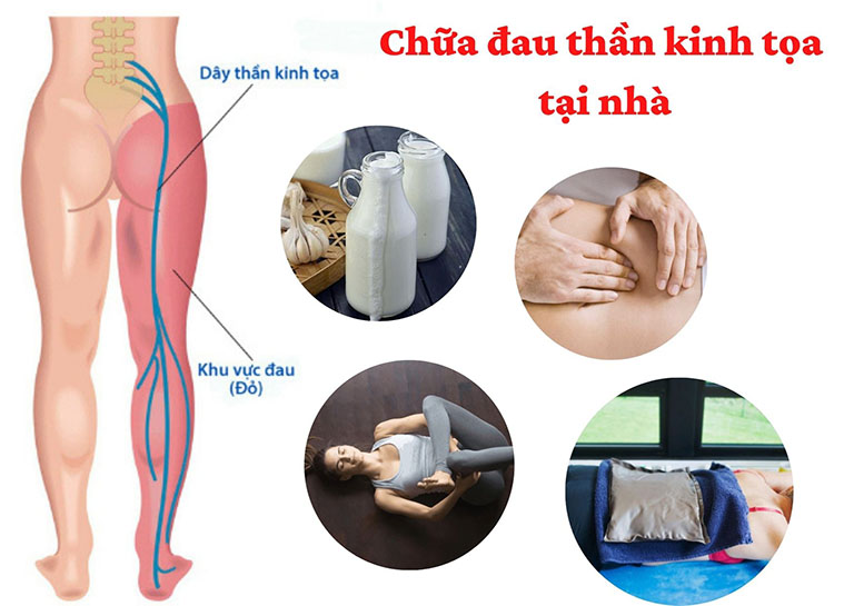 cách chữa đau thần kinh tọa