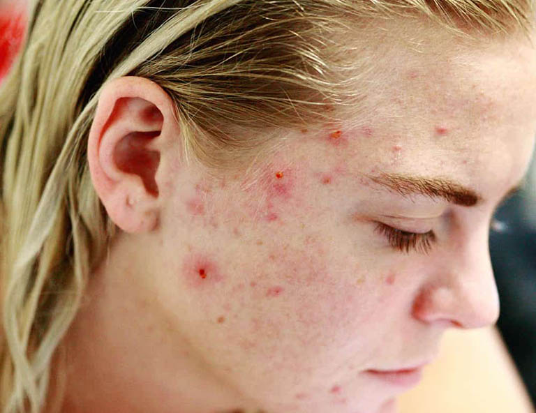 cách trị mụn bằng nha đam và kem đánh răng 