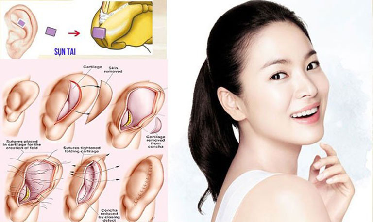 Da mũi mỏng có nâng mũi được không
