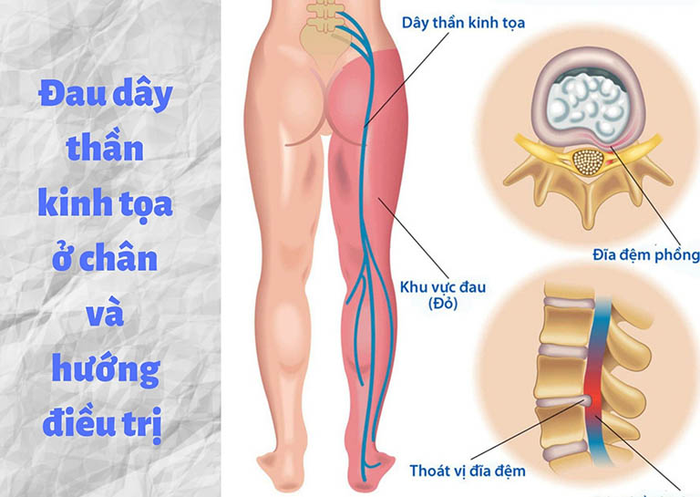 Đau dây thần kinh tọa ở chân