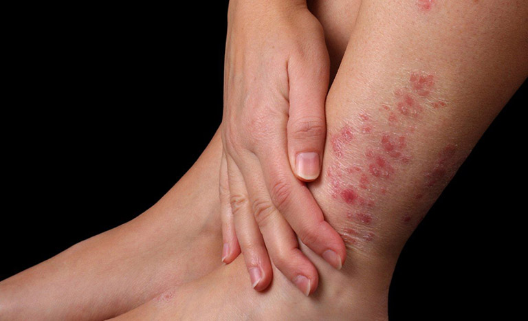 Mỏi khớp gối ở người trẻ tuổi
