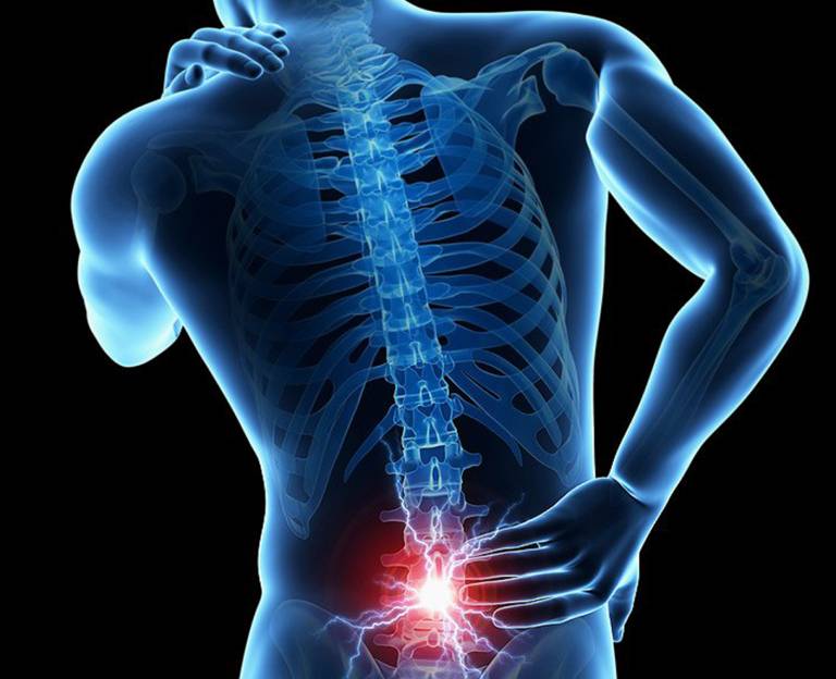 Nguyên nhân dẫn đến đau thần kinh tọa