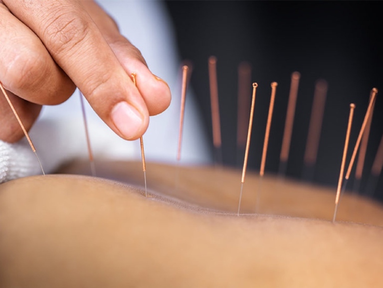 Ưu điểm của phương pháp châm cứu chữa đau thần kinh tọa