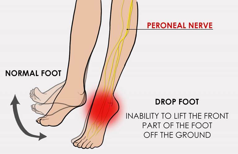 Đau thần kinh tọa có nguy hiểm không