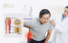 Đau thần kinh tọa có nguy hiểm không