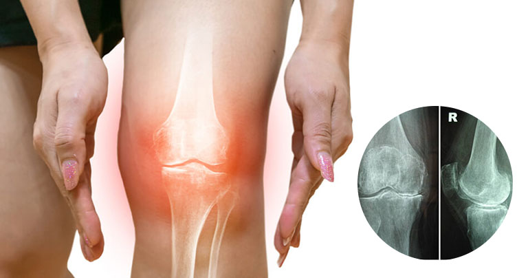 Hẹp khe khớp gối là gì