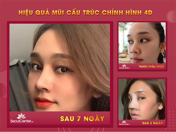 Nâng mũi cấu trúc 4D Seoul Center