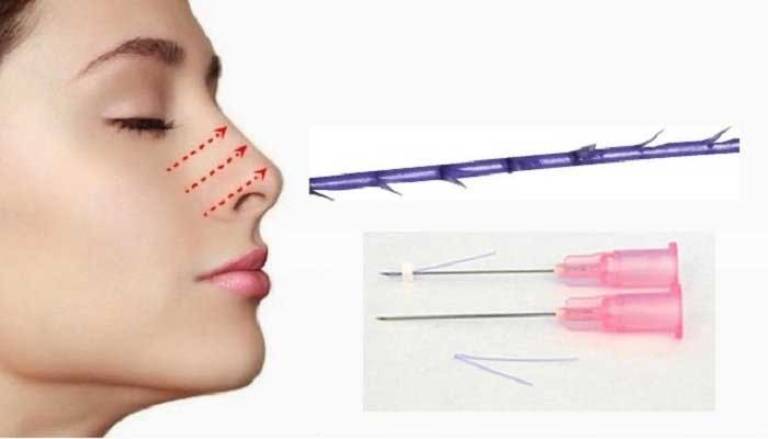 Phương pháp nâng mũi chỉ nguy hiểm không?