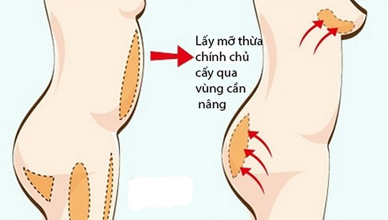 Nâng mũi không phẫu thuật có giá bao nhiêu