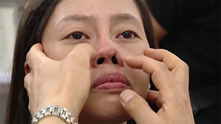 Nâng mũi sụn nhân tạo có vĩnh viễn không?