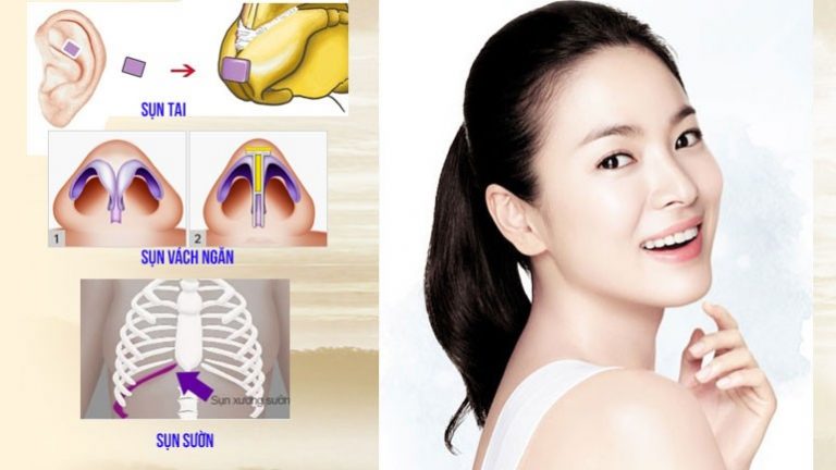 nâng mũi sụn tự thân là gì