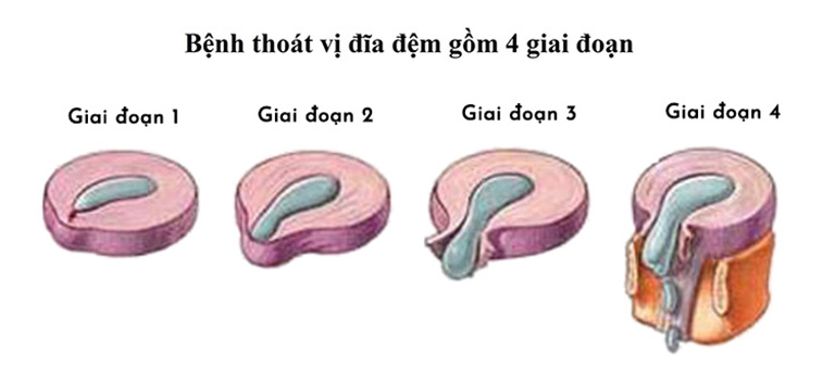 Rách vòng xơ đĩa đệm