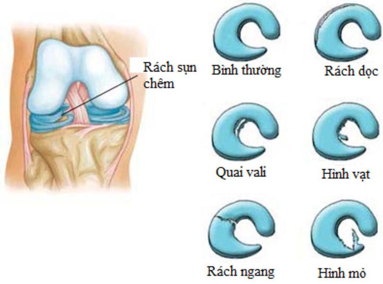 Rách sụn chêm khớp gối