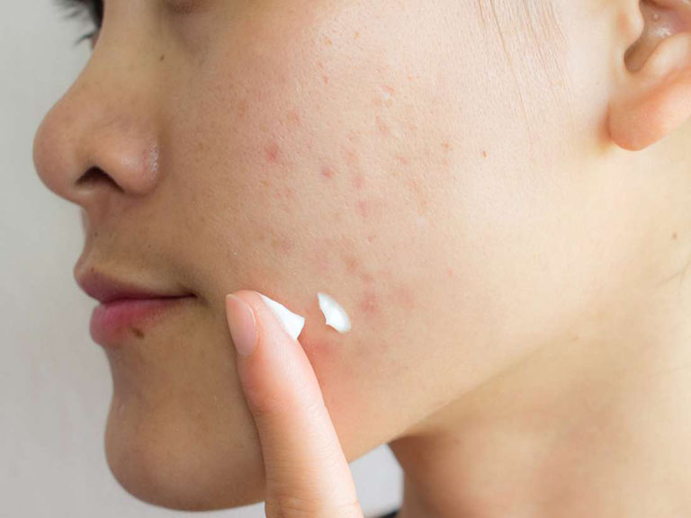 kem trị sẹo lõm lồi