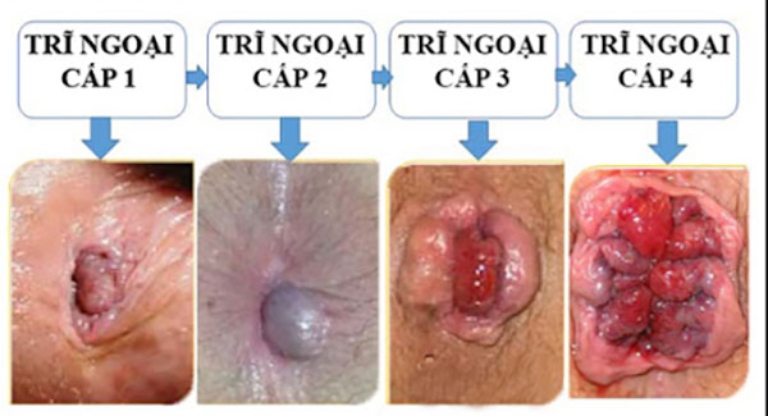 Hình ảnh nhận biết bệnh trĩ ngoại