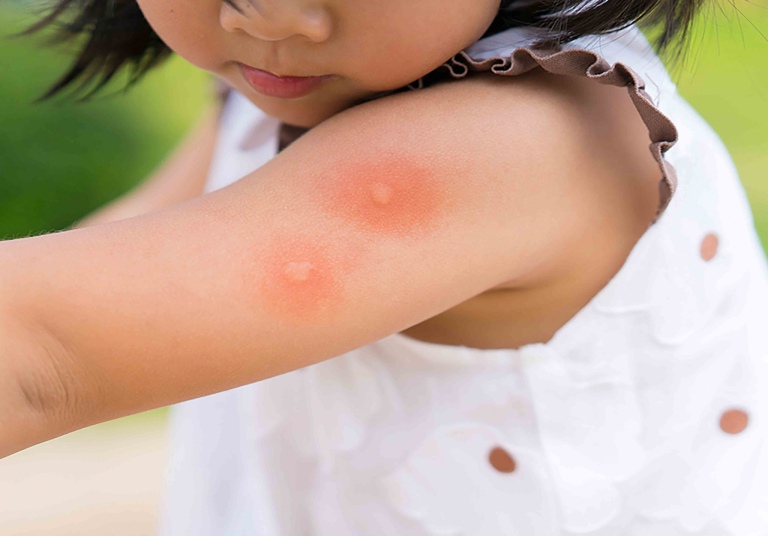 Những ai dễ bị bệnh sốt xuất huyết?
