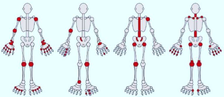 Tiêu chuẩn chẩn đoán bệnh viêm khớp dạng thấp thuộc Hội Thấp khớp học Hoa Kỳ (ACR) 1987