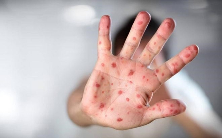 chăm sóc trẻ bị tay chân miệng