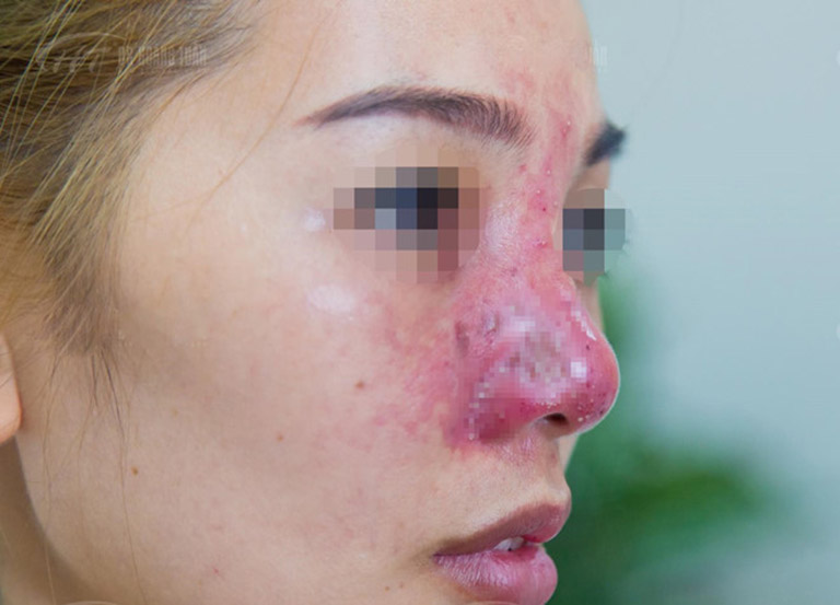 Dấu hiệu nhiễm trùng sau khi nâng mũi