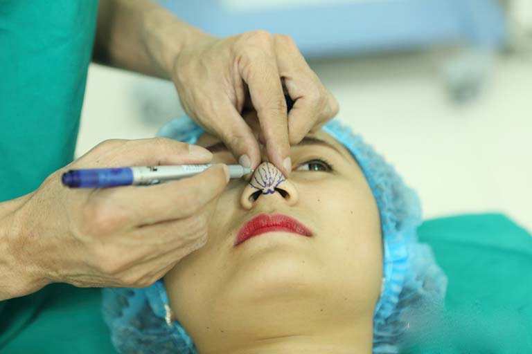 Dấu hiệu nhiễm trùng sau khi nâng mũi