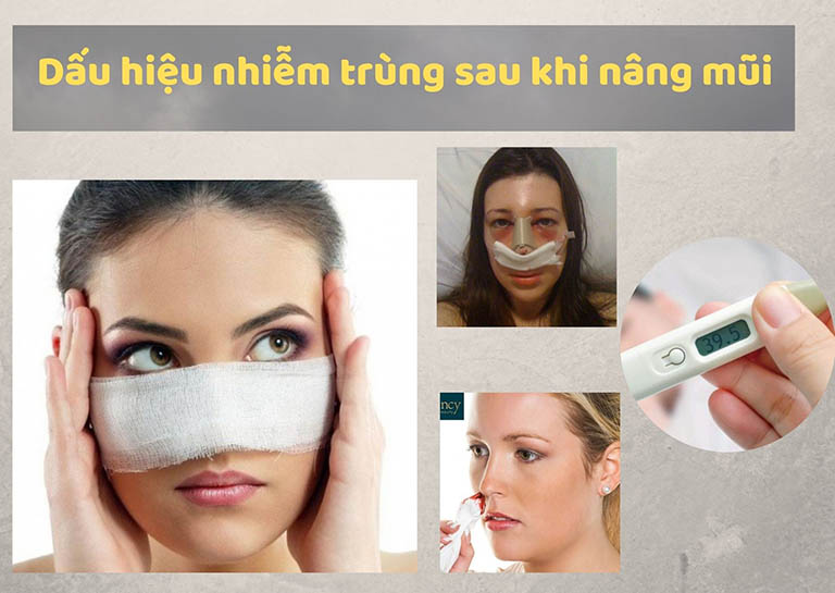 Dấu hiệu nhiễm trùng sau khi nâng mũi